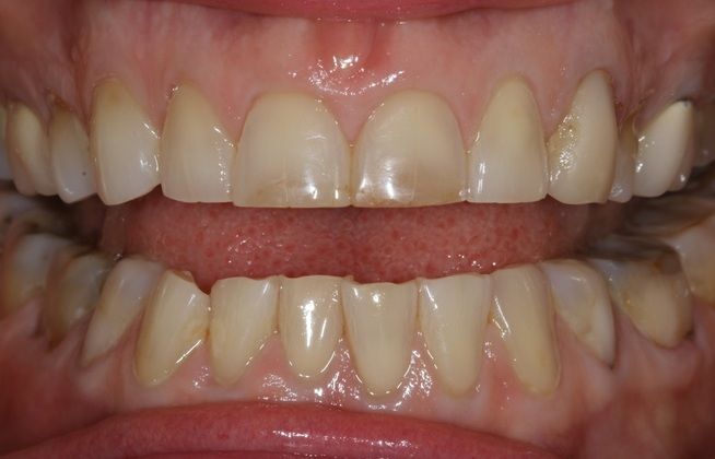 Full Mouth Rehabilitation: Kim - Before