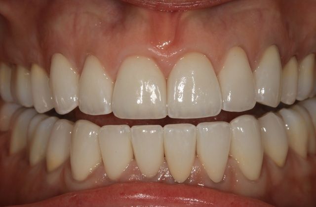 Full Mouth Rehabilitation: Kim - After