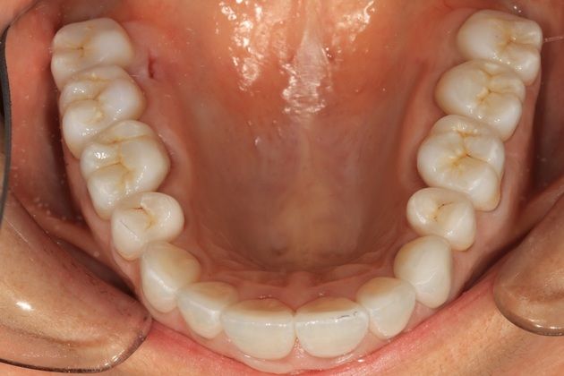 Full Mouth Rehabilitation: Kim - After