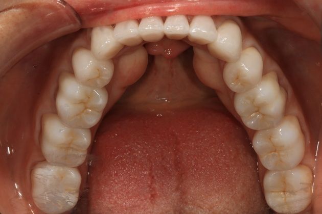 Full Mouth Rehabilitation: Kim - After