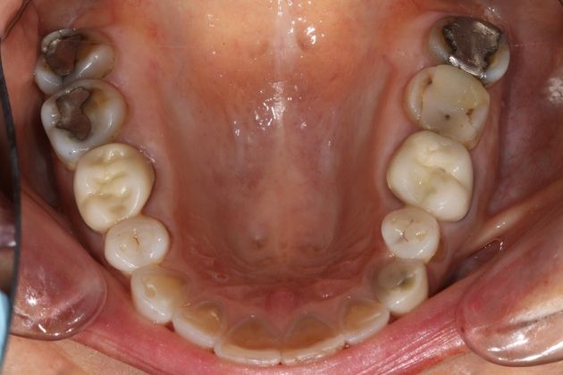 Full Mouth Rehabilitation: Kim - Before