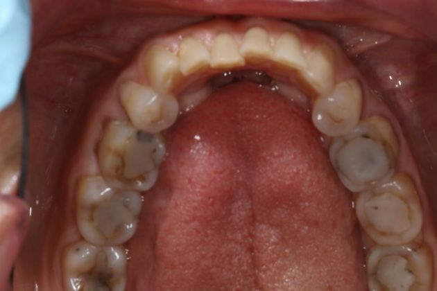 Full Mouth Rehabilitation: Kim - Before