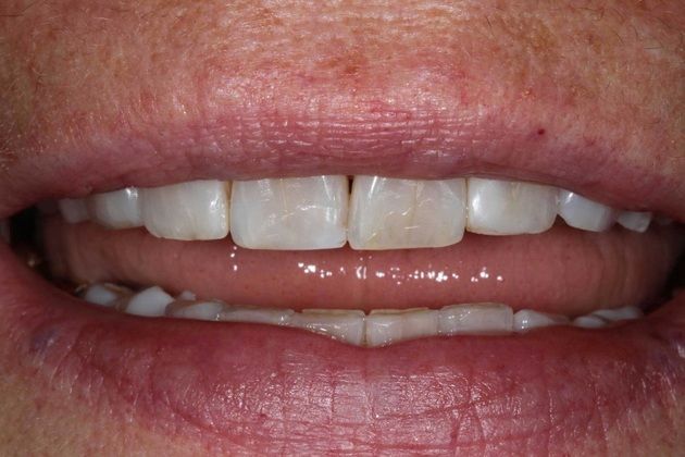 Porcelain Veneers: Lisa - Before