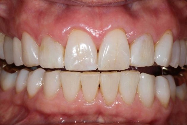 Porcelain Veneers: Lisa - Before