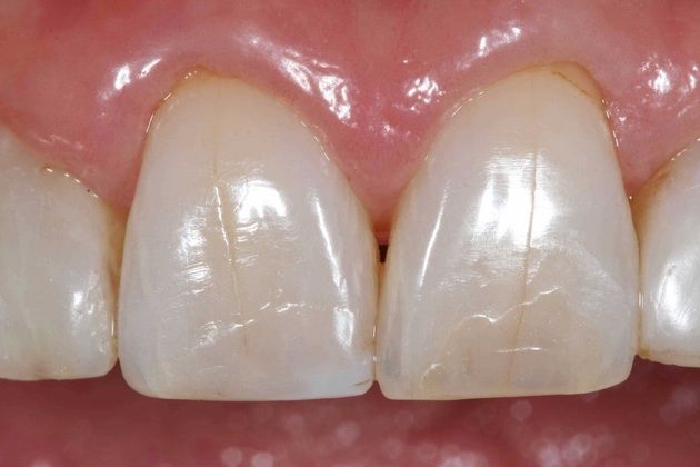 Porcelain Veneers: Lisa - Before