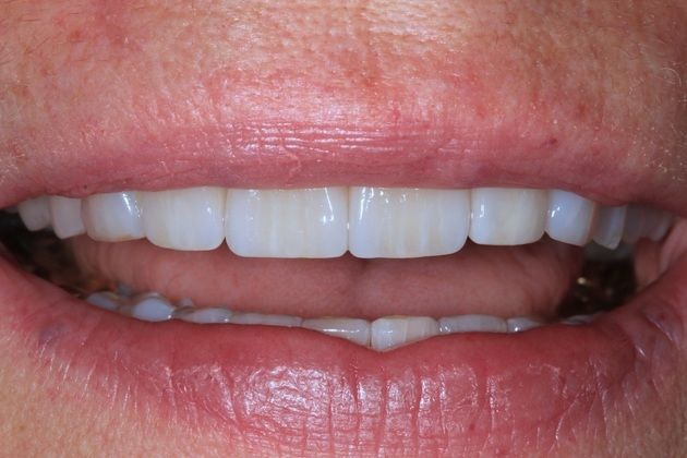 Porcelain Veneers: Lisa - After