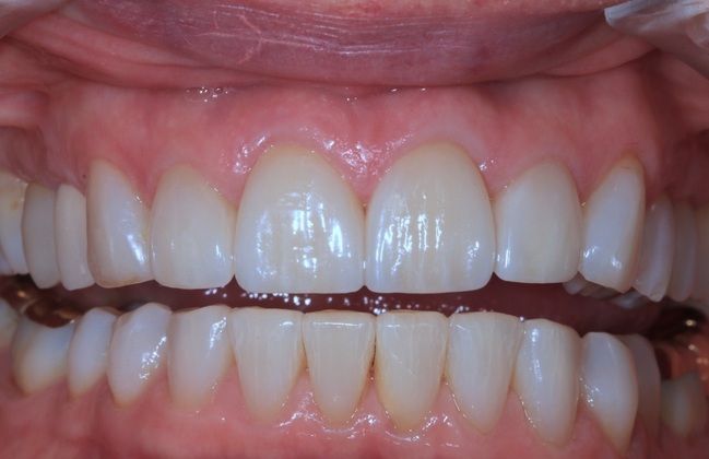 Porcelain Veneers: Lisa - After