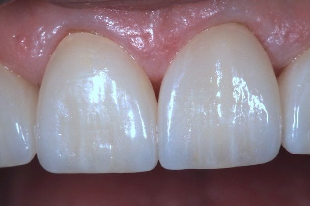 Porcelain Veneers: Lisa - After
