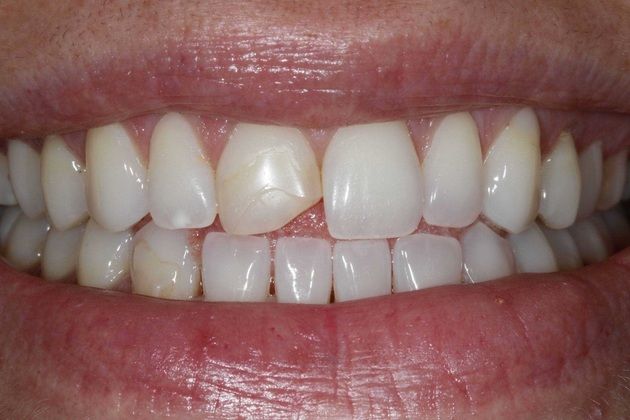 Dental Bonding: Camille - Before