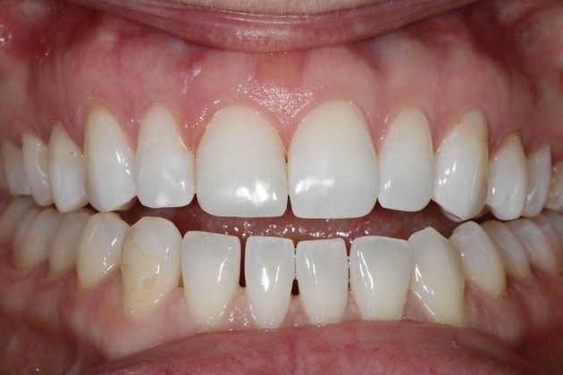 Dental Bonding: Camille - Before