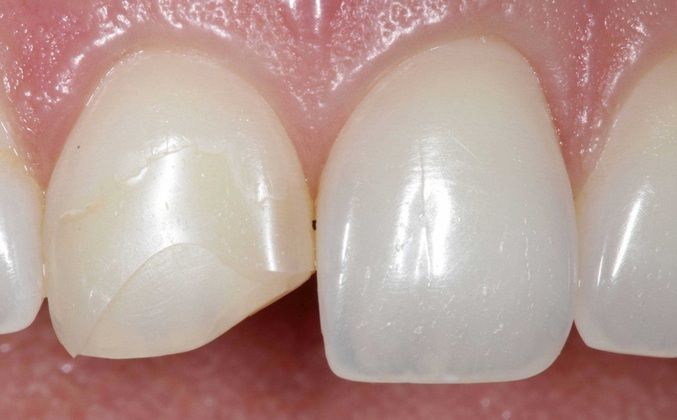 Dental Bonding: Camille - Before