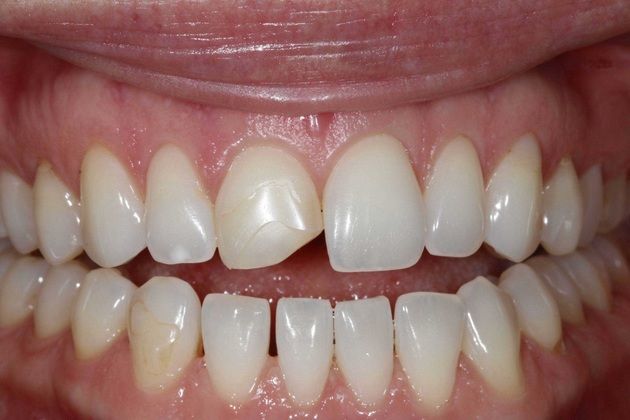 Dental Bonding: Camille - Before