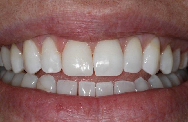 Dental Bonding: Camille - After