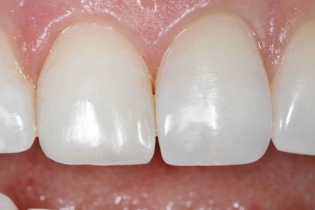 Dental Bonding: Camille - After