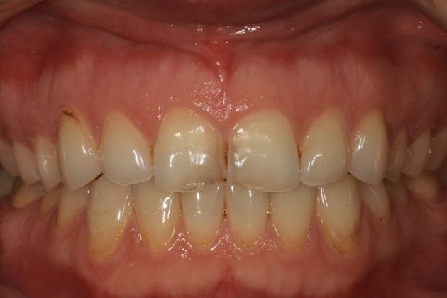 Porcelain crowns: Allison - Before