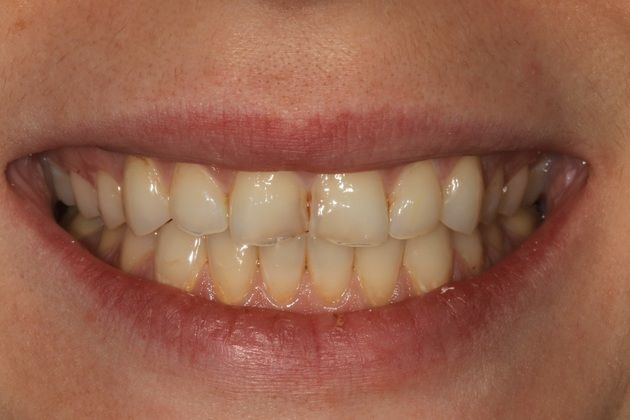 Porcelain crowns: Allison - Before