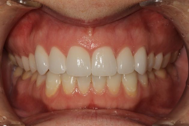 Porcelain crowns: Allison - After