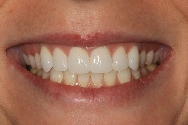 Porcelain crowns: Allison - After