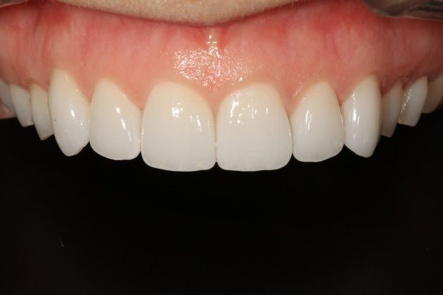 Porcelain crowns: Allison - After