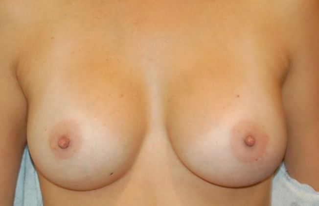 Breast Augmentation Case 494 - After