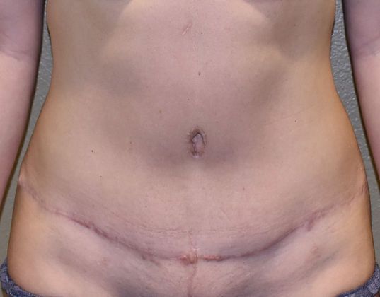 Tummy Tuck (Abdominoplasty) Case 163 - After