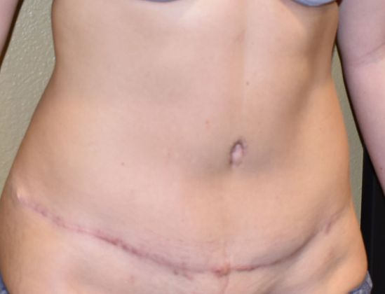 Tummy Tuck (Abdominoplasty): Case 163 - After