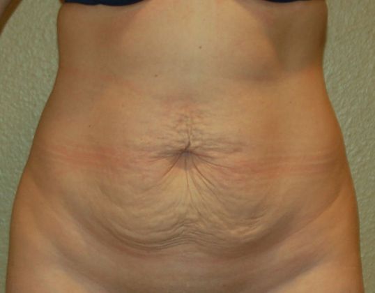 Tummy Tuck (Abdominoplasty) Case 163 - Before