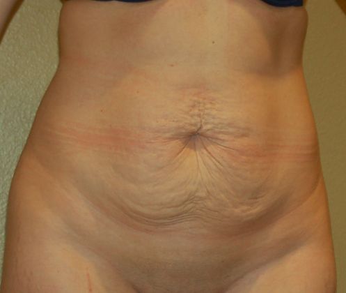Tummy Tuck (Abdominoplasty): Case 163 - Before