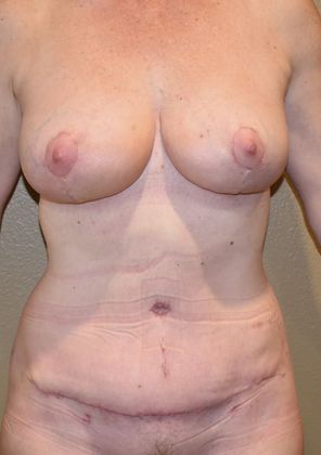 Mommy Makeover Case 115 - After