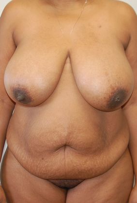 Mommy Makeover Case 116 - Before