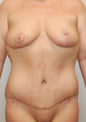 Mommy Makeover Case 117 - After