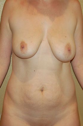 Mommy Makeover Case 120 - Before