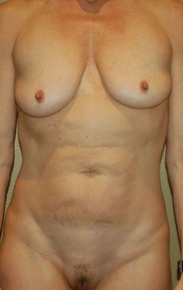 Mommy Makeover Case 121 - Before