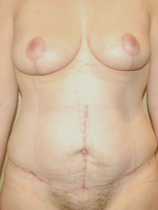 Mommy Makeover Case 123 - After