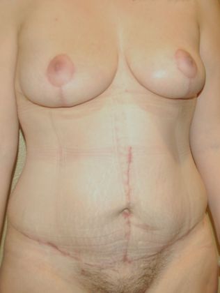 Mommy Makeover: Case 123 - After