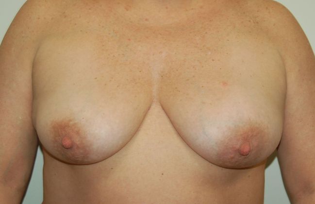 Breast Augmentation w/ Lift: Case 250 - Before