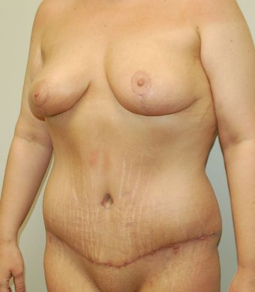 Massive Weight Loss : Case 52 - After