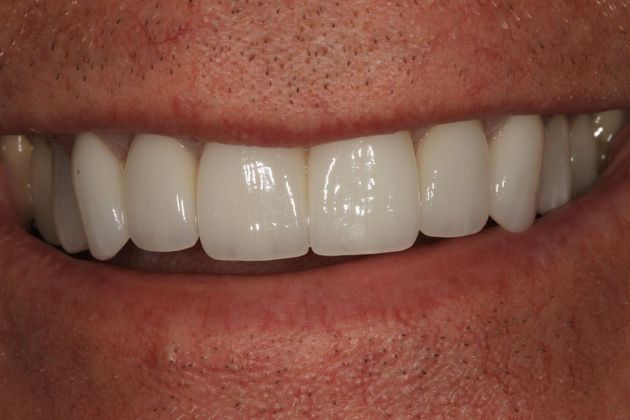 Smile Makeover: Peter - After