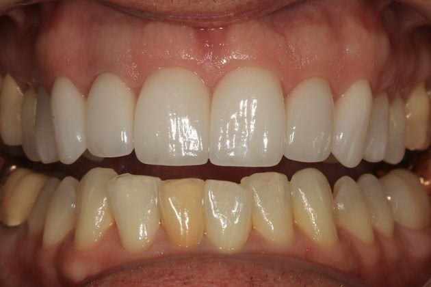 Smile Makeover: Peter - After