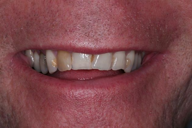 Smile Makeover: Peter - Before