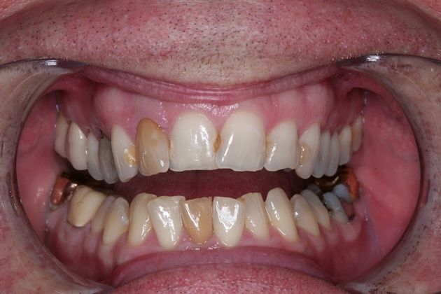 Smile Makeover: Peter - Before