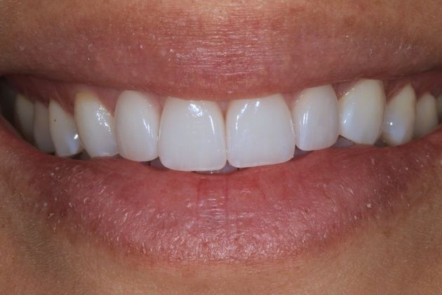 Smile Makeover: Sara