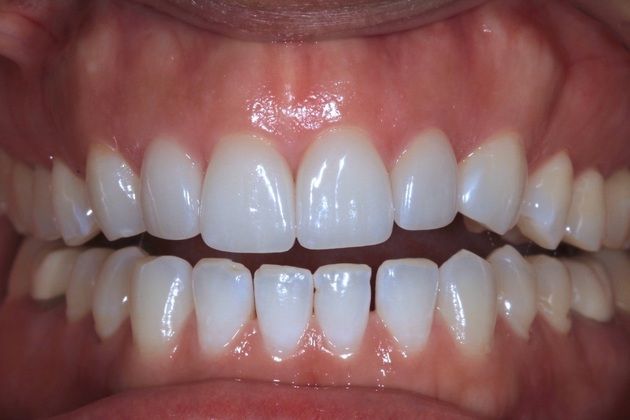 Smile Makeover: Sara