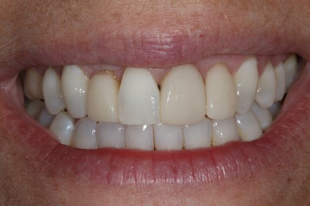 Smile Makeover: Jennifer - Before