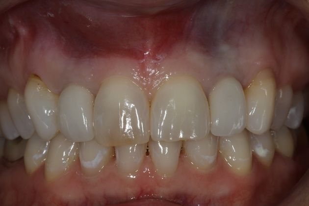 Dental Bonding: denise - Before