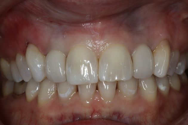 Dental Bonding: denise - After