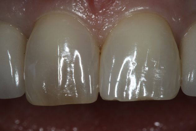 Dental Bonding: denise - Before