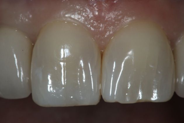 Dental Bonding: denise - After