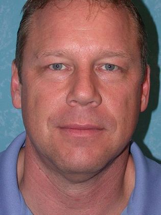 Face & Neck Lifts: Case 1333- Petersburg, OH - Before