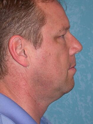 Face & Neck Lifts Case 1333- Petersburg, OH - Before